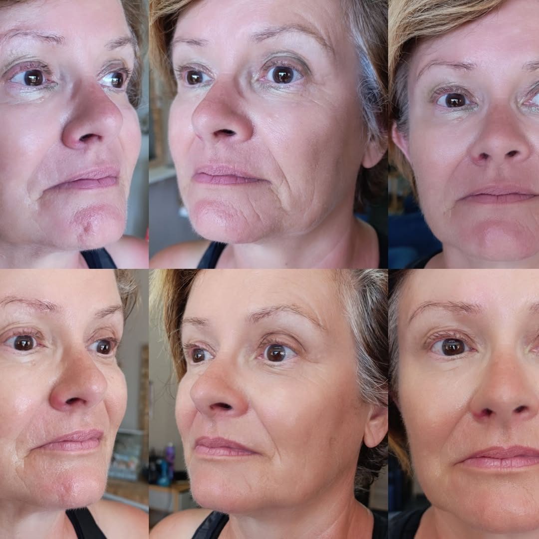 Six photos d'un même visage montrant l'évolution de la peau au fil des séances